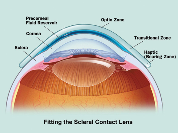 121012 scleral contact lens corneal disease opu0102 2col